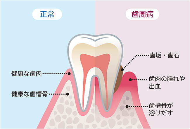 正常な歯と歯周病になった歯のイラスト