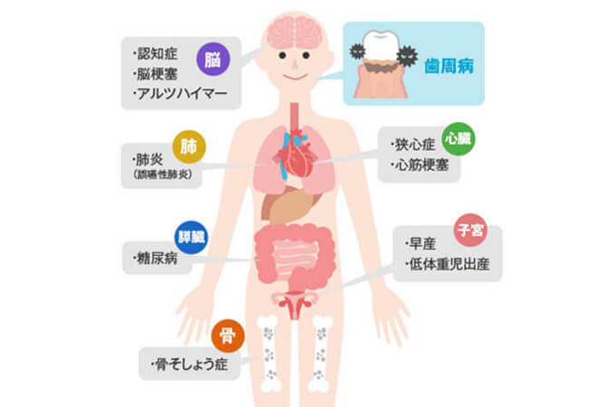 歯周病が全身に及ぼす影響のイラスト