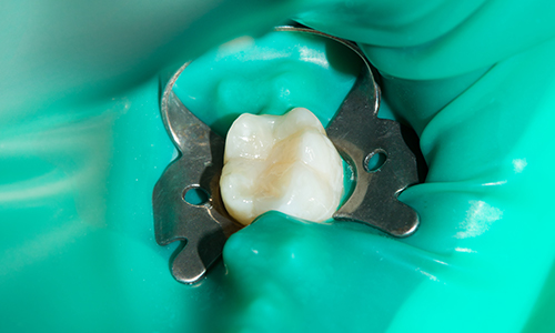 ラバーダムのイメージ