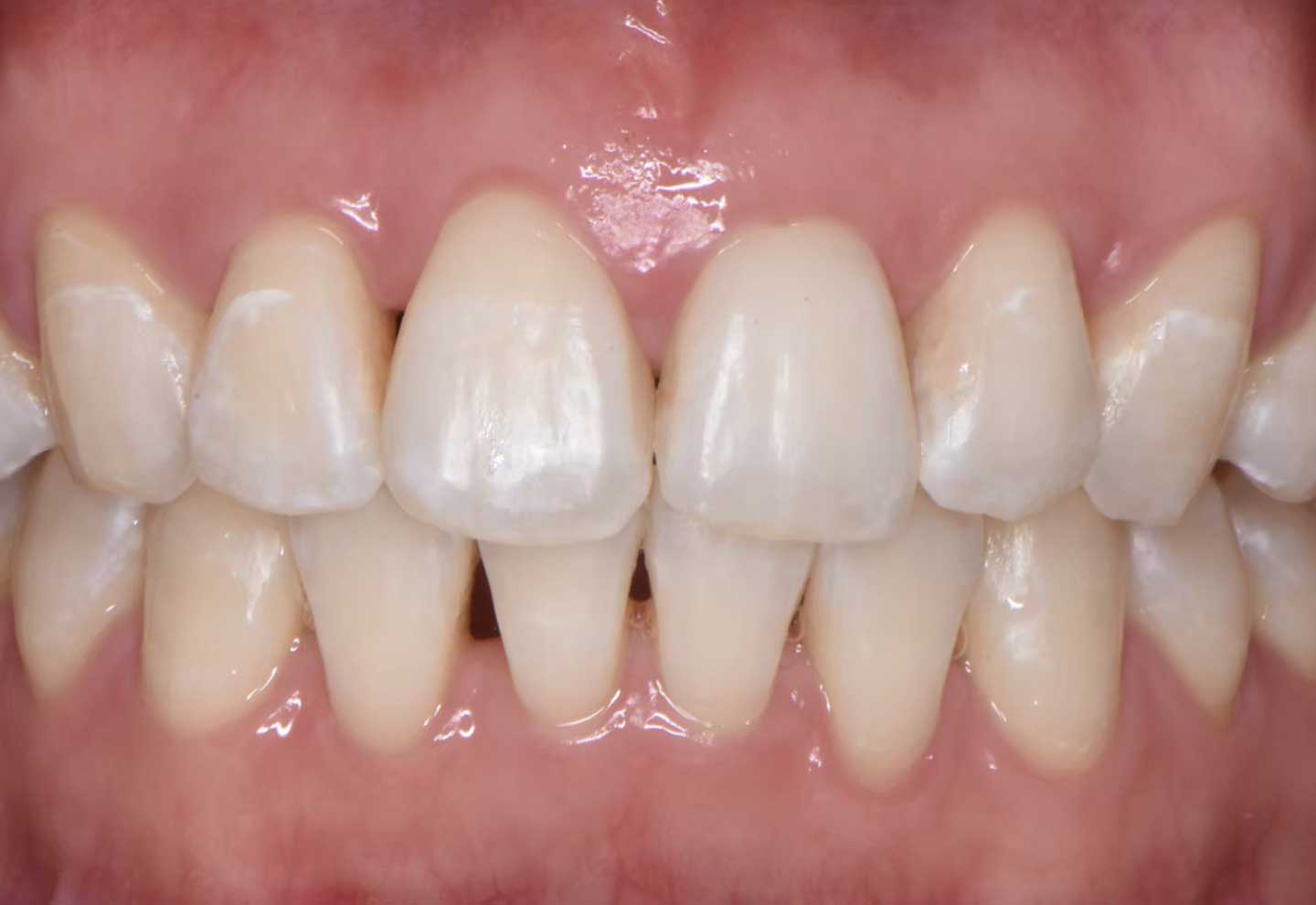 ホワイトニング 治療後