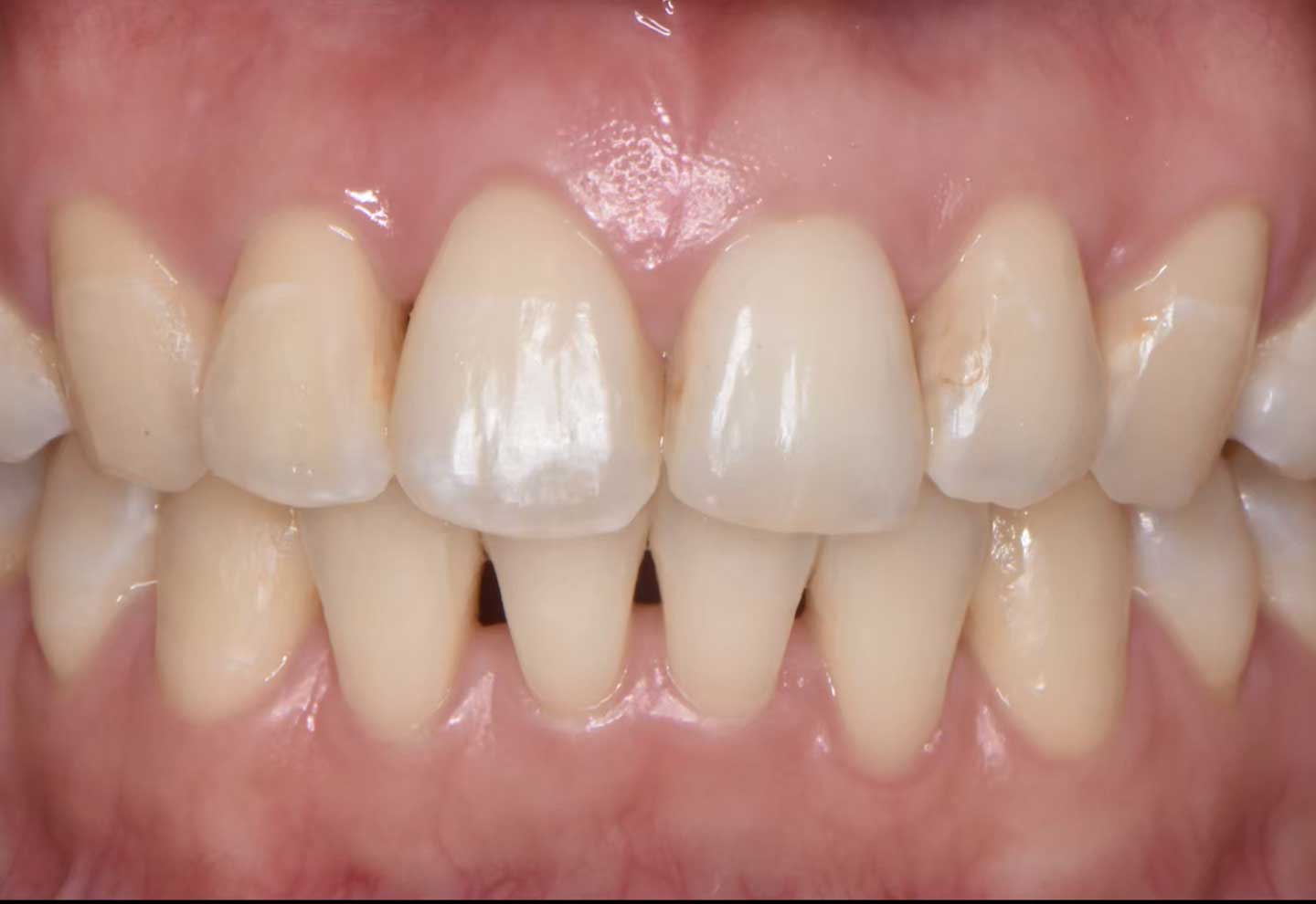 ホワイトニング 治療前