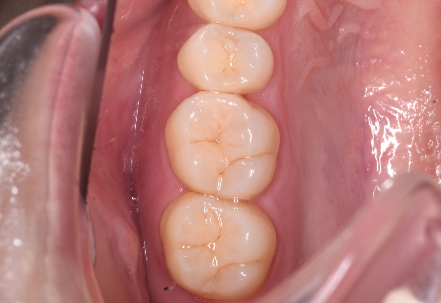 e-max（改良型オールセラミック） 治療後