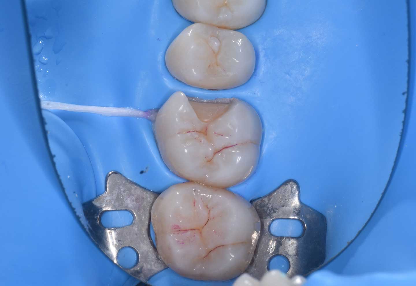 e-max（改良型オールセラミック） 治療前